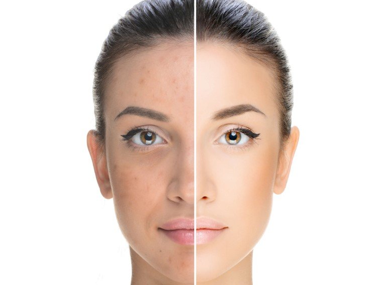 microneedling services in Lake Mary